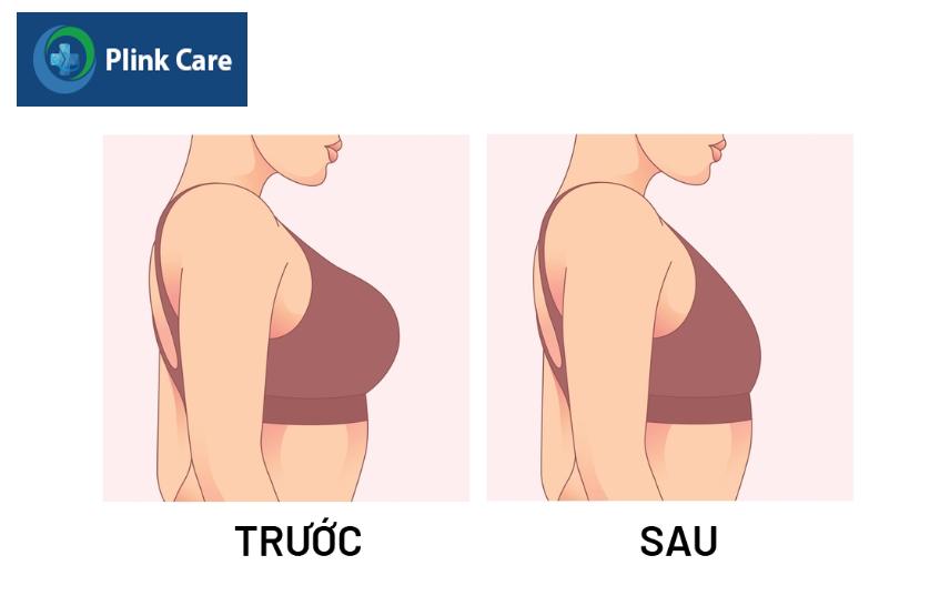 thu nhỏ vú không phẫu thuật