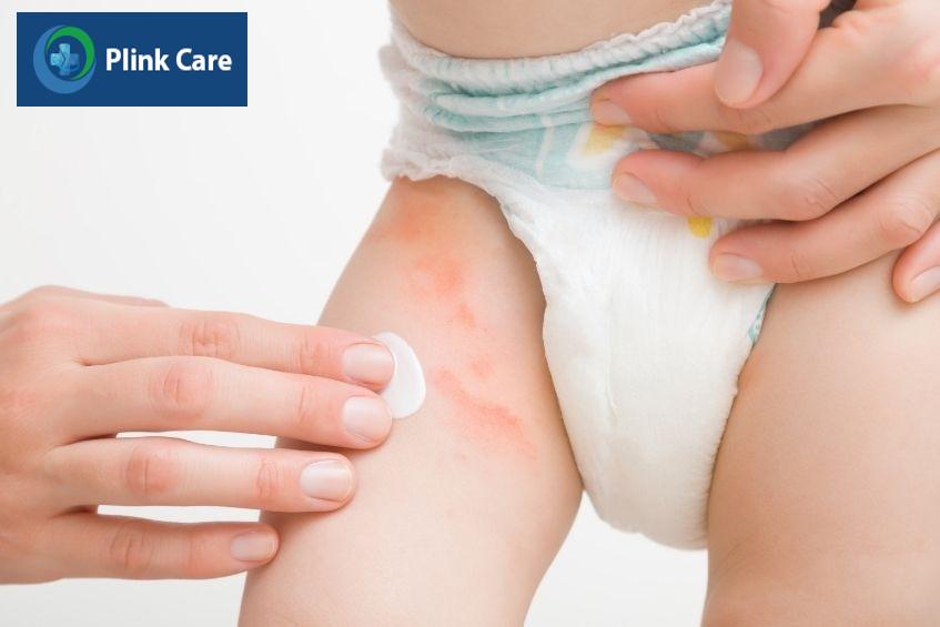 Thuốc bôi ngoài da hoàn toàn có thể trị bướu máu tại nhà