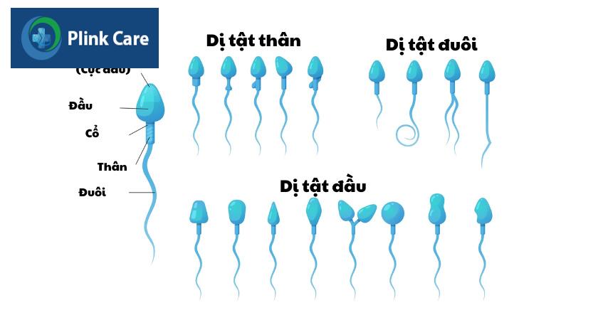 tinh trùng có thể bất thường hình thái phần đầu, phần thân hoặc phần đuôi