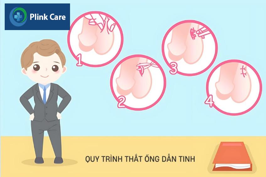 tổng quan về thắt ống dẫn tinh