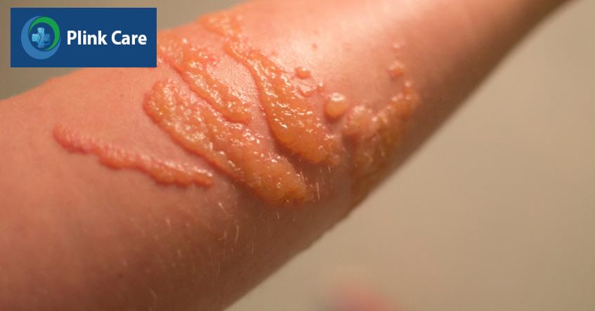 triệu chứng Pemphigus trên da khi mới phát bệnh