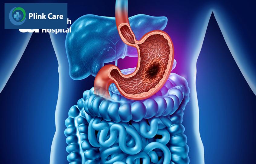 ung thư dạ dày nên ăn gì và kiêng gì đóng vai trò rất quan trọng