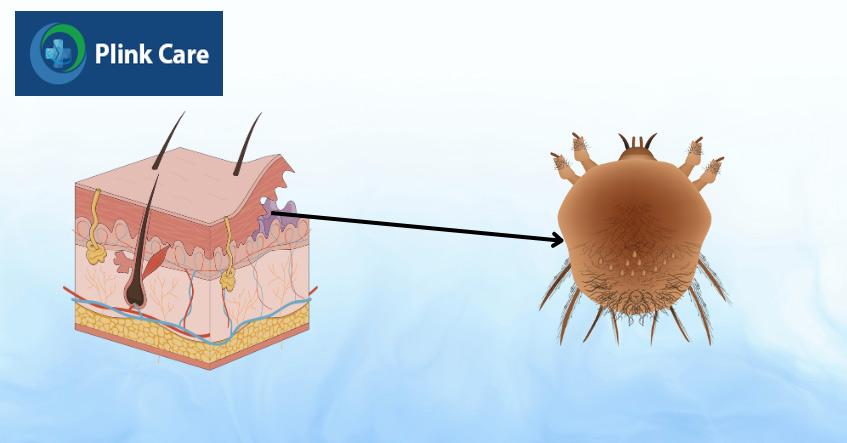 ve ghẻ thường ký sinh ở lớp sừng của da
