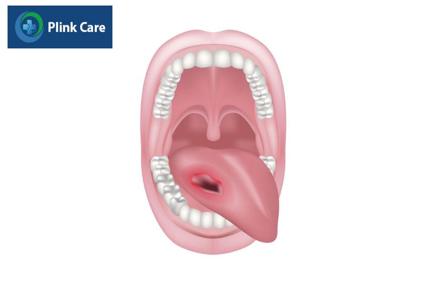 vết loét lâu lành trên lưỡi