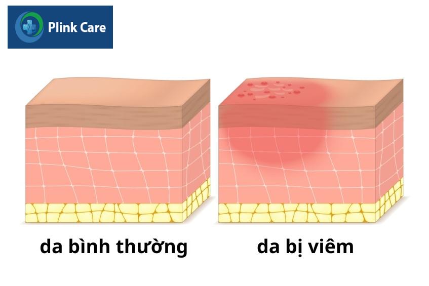 viêm da tiếp xúc kích ứng