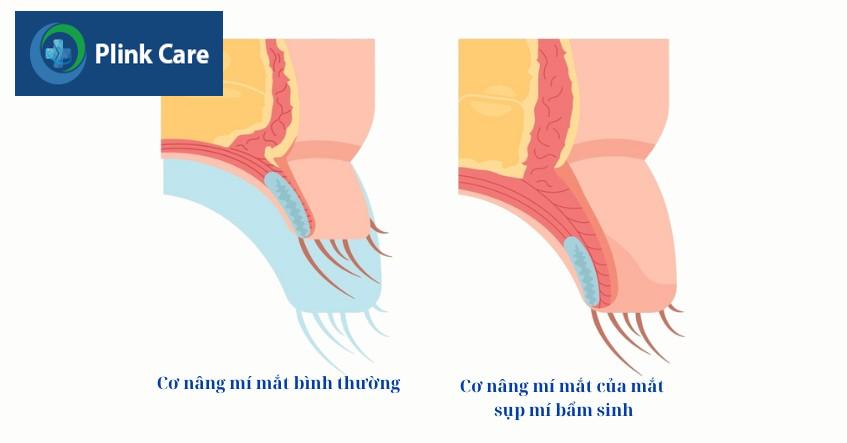 bất thường cơ mí mắt gây sụp mí bẩm sinh