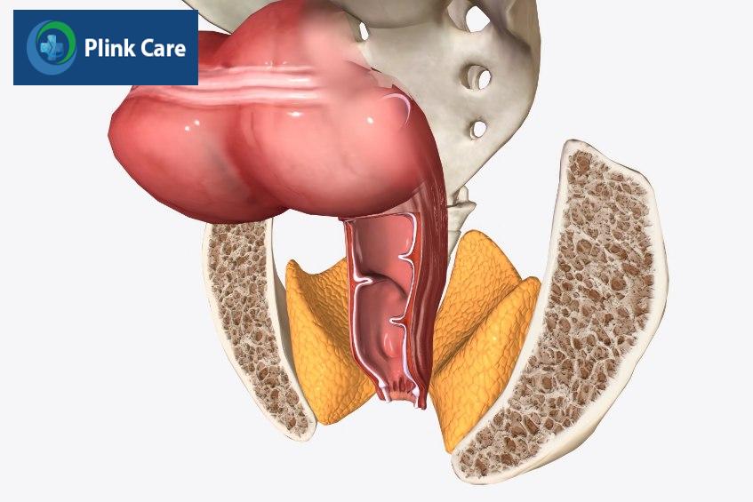 bị rò hậu môn áp xe hóa