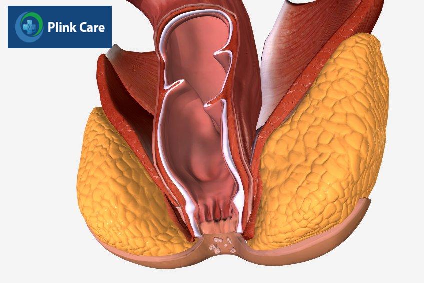 bị rò hậu môn xuyên cơ thắt