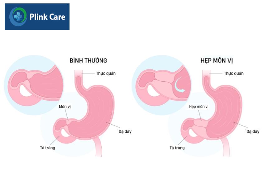 Biến chứng hẹp môn vị do viêm loét dạ dày tá tràng