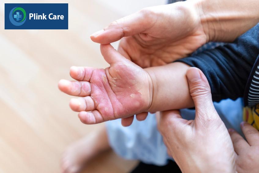 Bỏng khiến da trẻ sưng đỏ