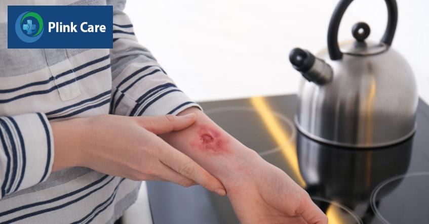 bỏng là vết thương trên da hoặc các mô hữu cơ khác
