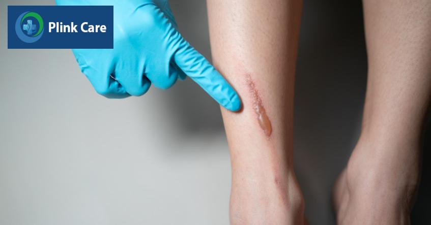 bỏng nước sôi gây tổn thương mô và các tế bào