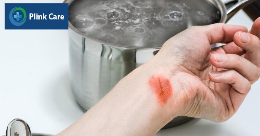 bỏng nước sôi là vết thương trên da