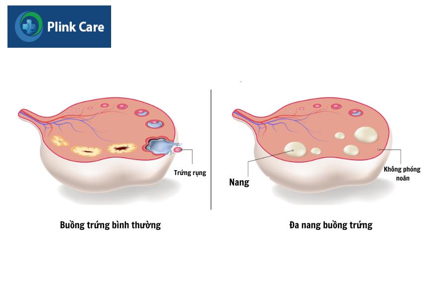 Buồng trứng đa nang có sự hiện diện của ít nhất 12 nang noãn kích thước 2-9mm