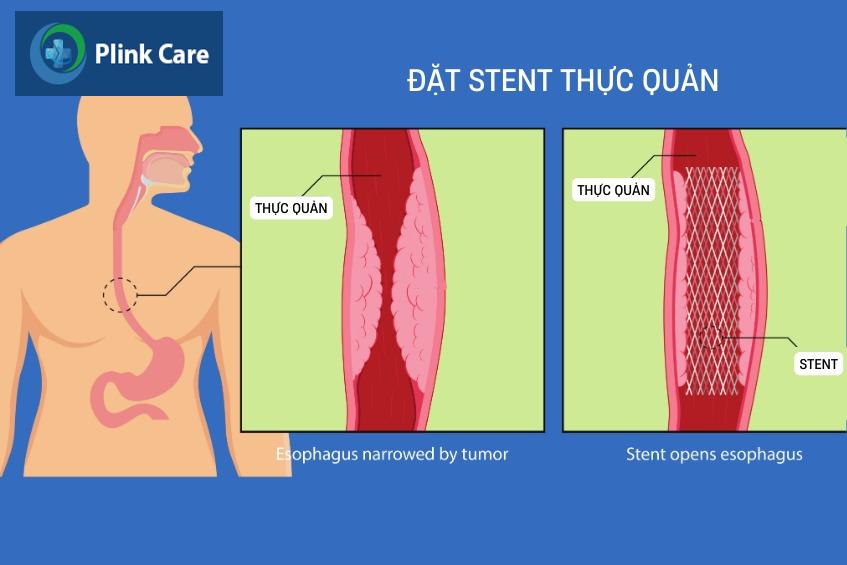 cách chữa hẹp thực quản