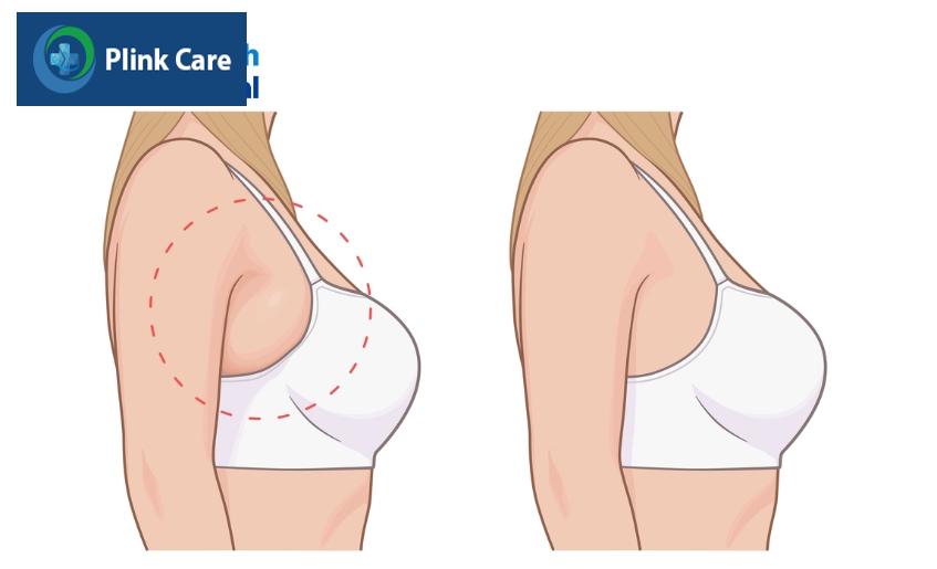 cắt bỏ tuyến vú phụ ở nách