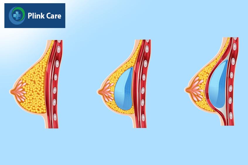 câu hỏi trước khi đặt túi ngực
