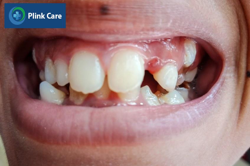 Cấu trúc răng bất thường, trẻ dễ gặp các vấn đề về răng