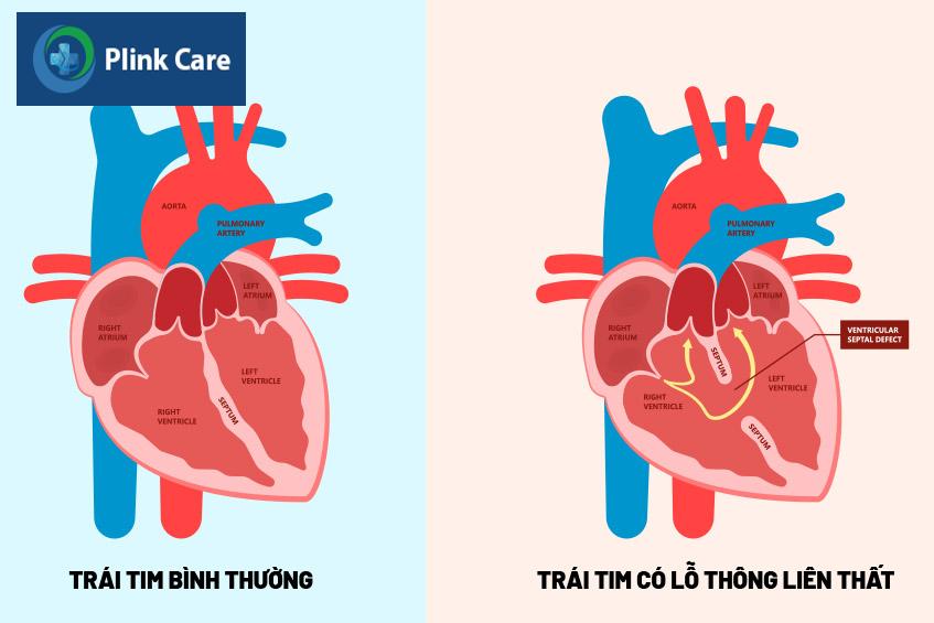 Cấu trúc tim bình thường và tim có lỗ thông liên thất