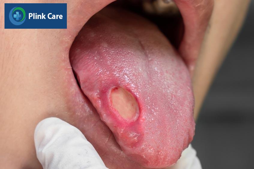 chỉ định phẫu thuật dựa vào vị trí, kích thước khối u
