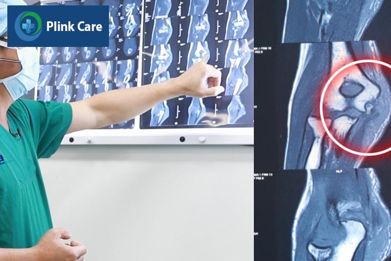 Chẩn đoán hình ảnh giúp bác sĩ phát hiện tổn thương kèm theo viêm cơ đầu gối