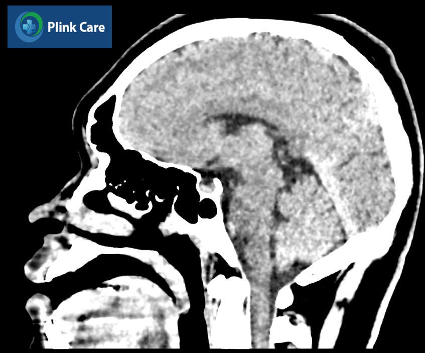 ct não có ảnh hưởng gì không