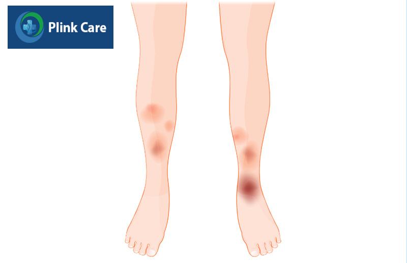 Dấu hiệu và triệu chứng của bệnh hồng ban nút