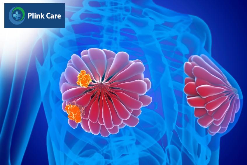 dấu hiệu ung thư vú giai đoạn đầu