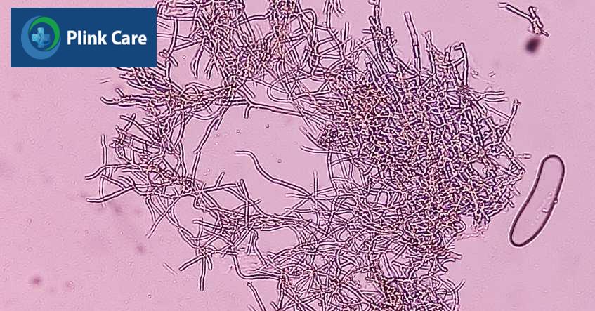 dermatophytes là nguyên nhân chủ yếu gây nấm da đầu