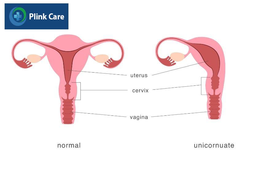 Các dị tật ở ống dẫn trứng có thể tăng nguy cơ thai ngoài tử cung sau chuyển phôi IVF