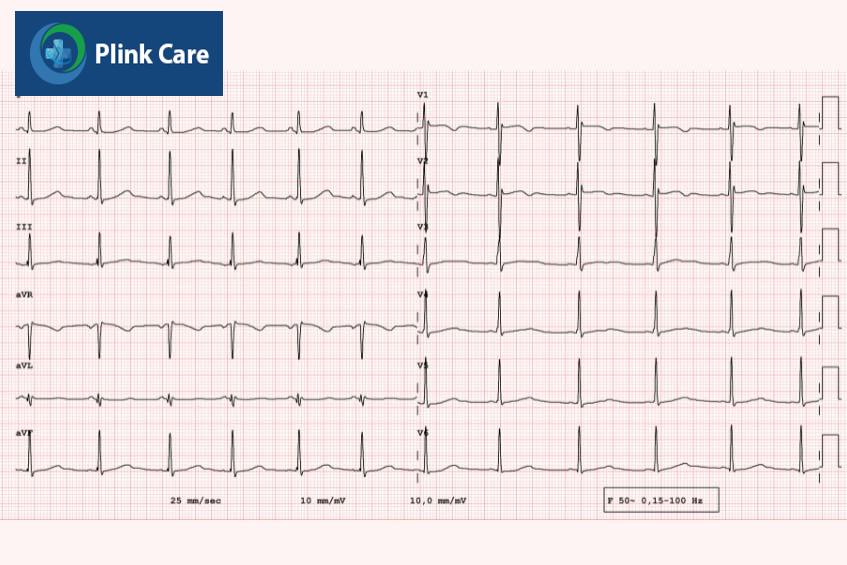 ecg qt dài