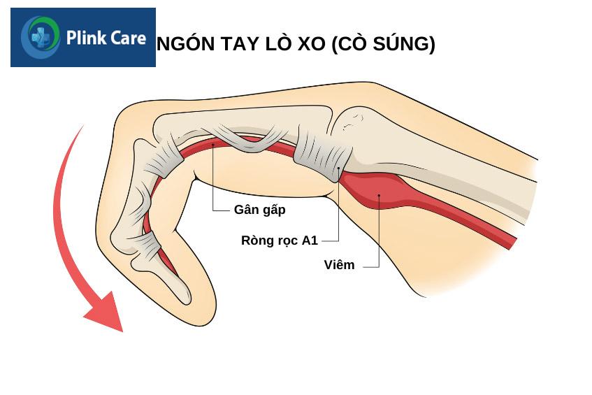 Gân gấp ngón tay là gì?