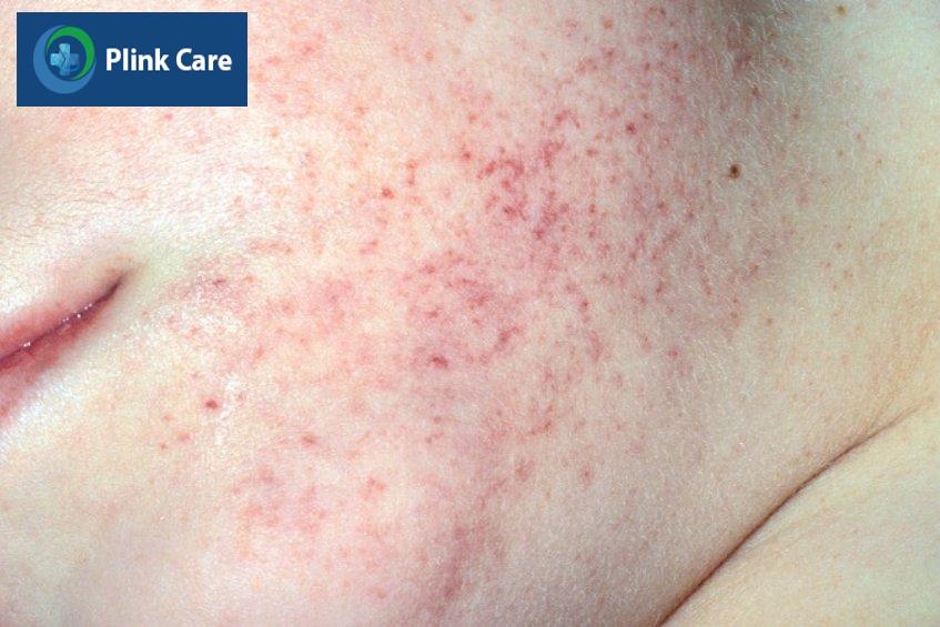 hạ tiểu cầu là biểu hiện lâm sàng