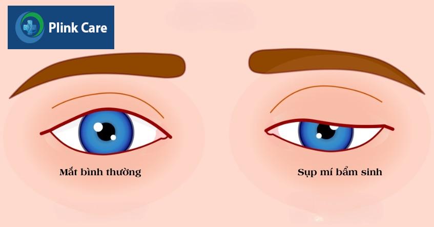 hiện tượng sụp mí bẩm sinh