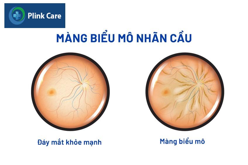 hình ảnh bệnh màng trước võng mạc