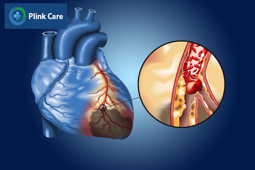 Hình ảnh các mảng xơ vữa và cục máu đông làm tắc nghẽn động mạch, nguyên nhân gây ra bệnh mạch vành