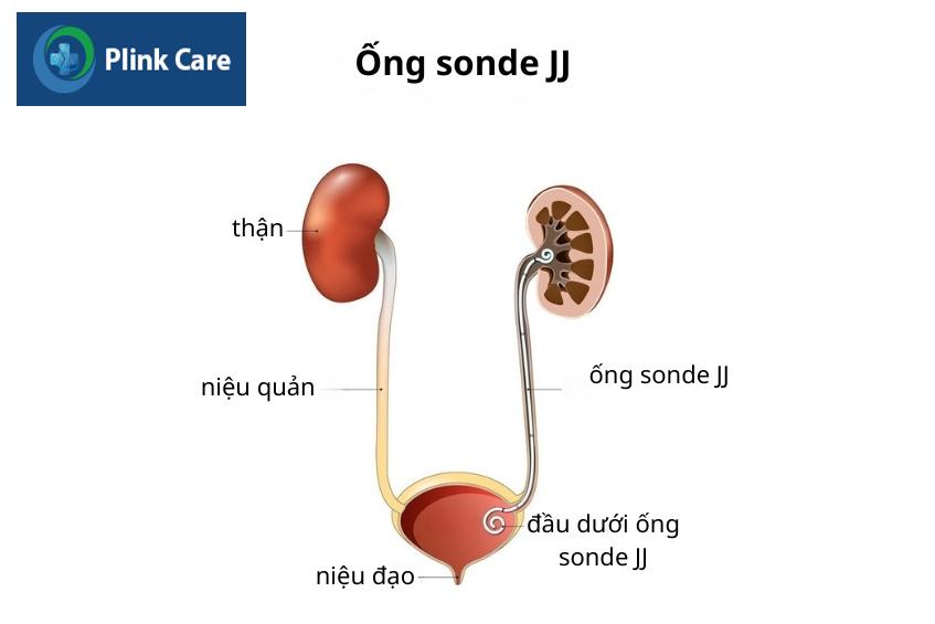hình ảnh ống sonde jj