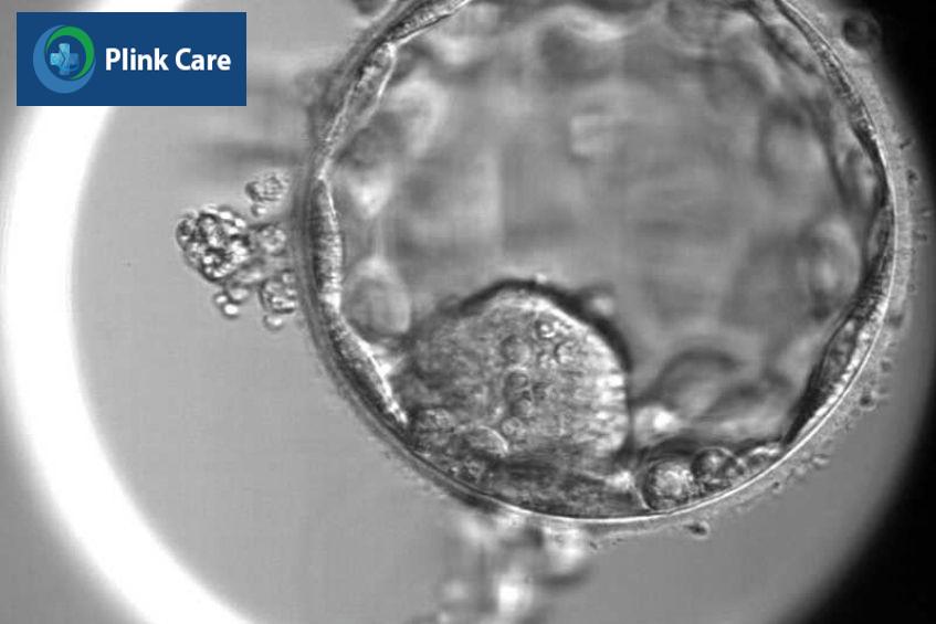 Hình ảnh phôi ngày 5 chuẩn bị thoát màng tại LAB IVF Tâm Anh
