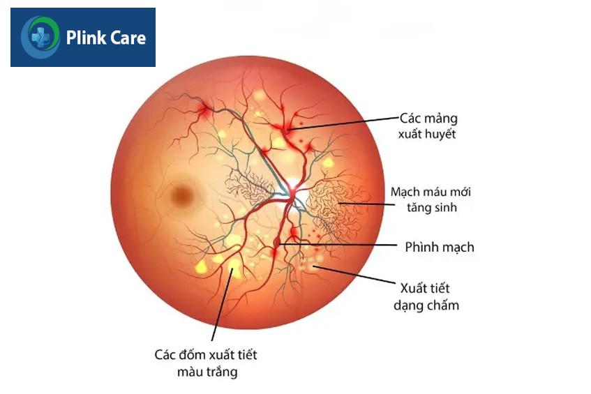 hình ảnh tăng sinh dịch kính võng mạc