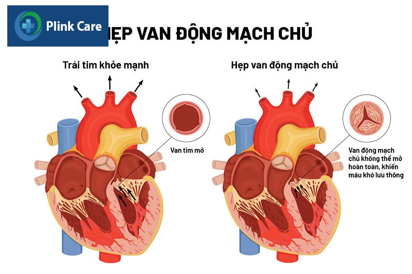 Hình ảnh trái tim bình thường và trái tim bị hẹp van động mạch chủ