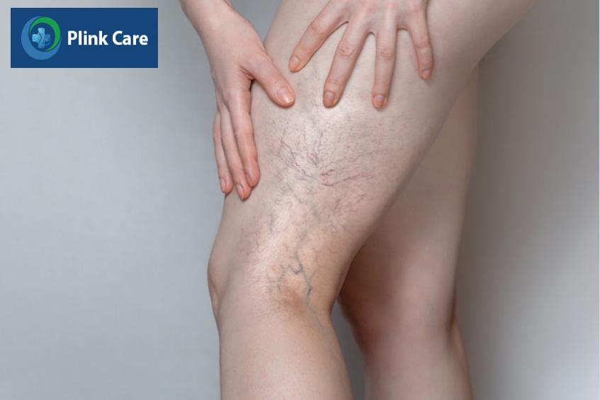Huyết khối tĩnh mạch sâu thường xảy ra ở cẳng chân và đùi