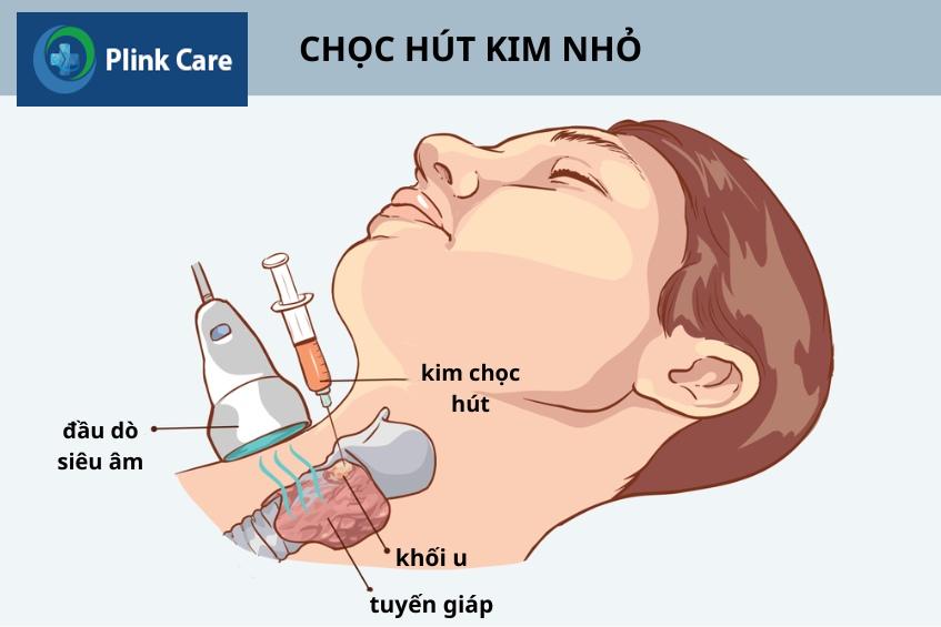 khám u tuyến giáp bằng chọc hút kim nhỏ