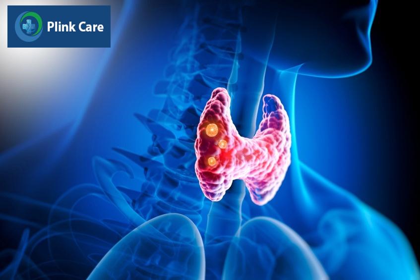 khối u tuyến giáp cần khám ngay