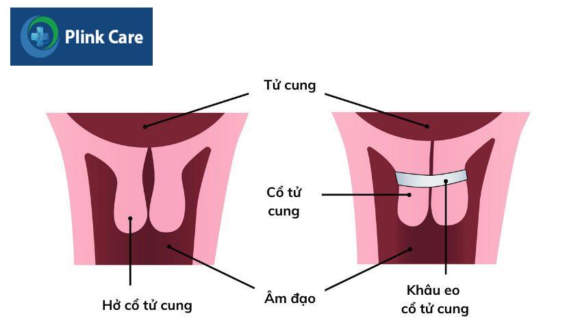 kỹ thuật giúp cổ tử cung đóng lại