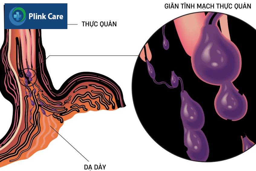 kỹ thuật thắt tĩnh mạch thực quản