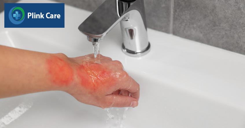 làm dịu vết bỏng nước sôi dưới vòi nước lạnh