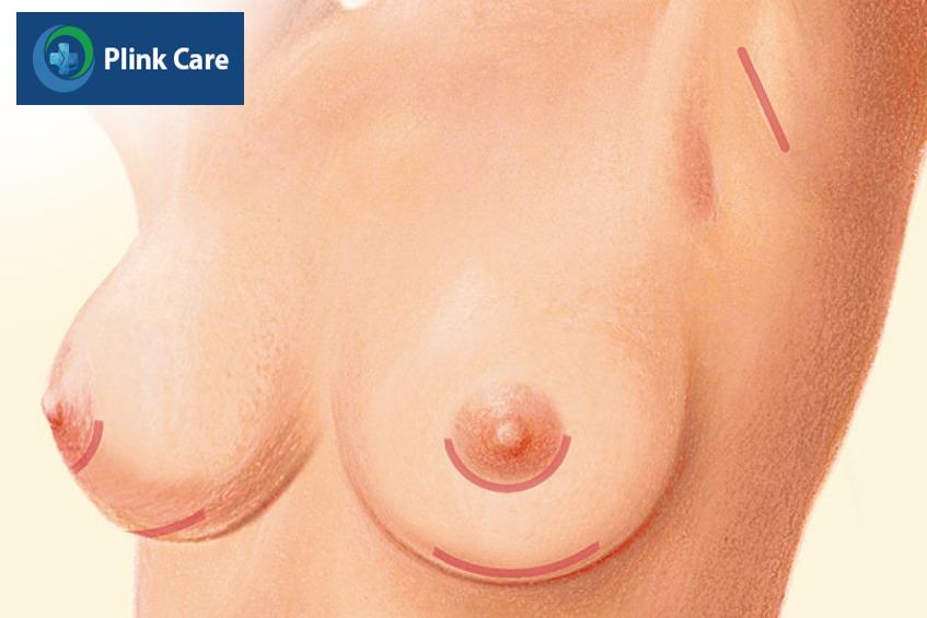lưu ý trước khi đặt túi ngực