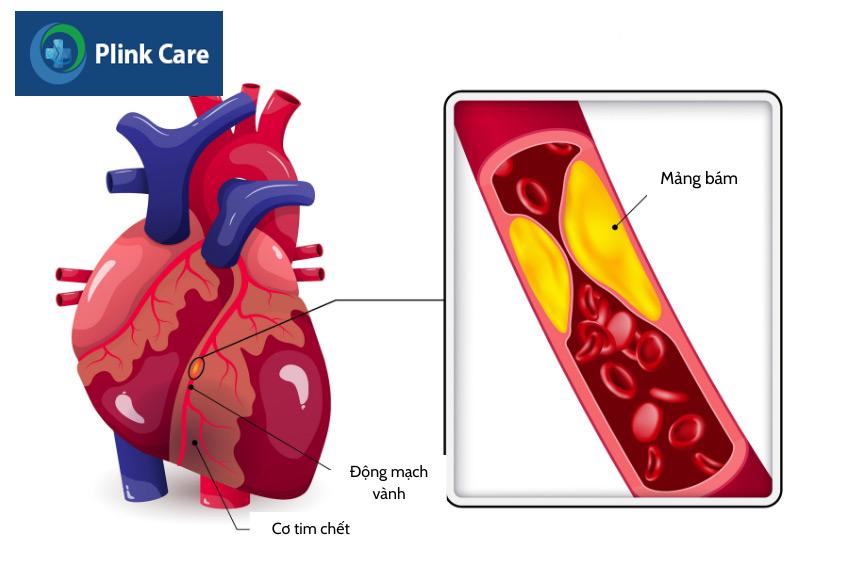 Các mảng xơ vữa trong lòng động mạch gây tắc nghẽn dòng máu đến tim