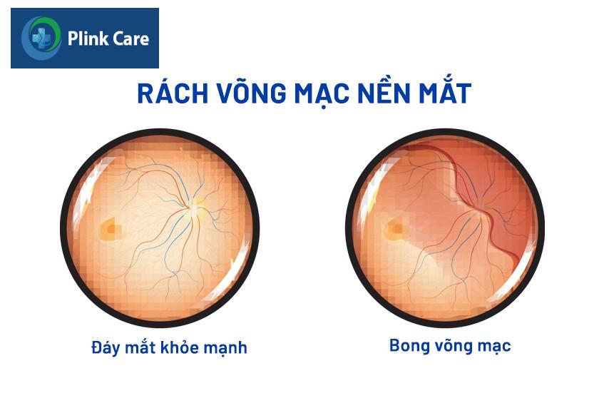 mắt bị rách võng mạc