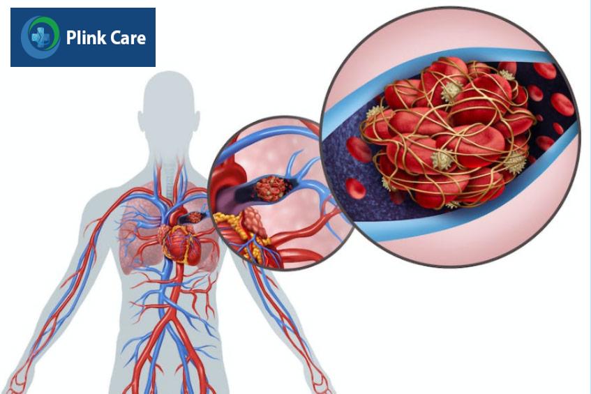 Máu đông di chuyển đến các mạch máu trong phổi gây thuyên tắc phổi